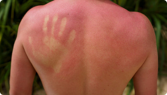 Three Tips To Treat Your Sunburn!